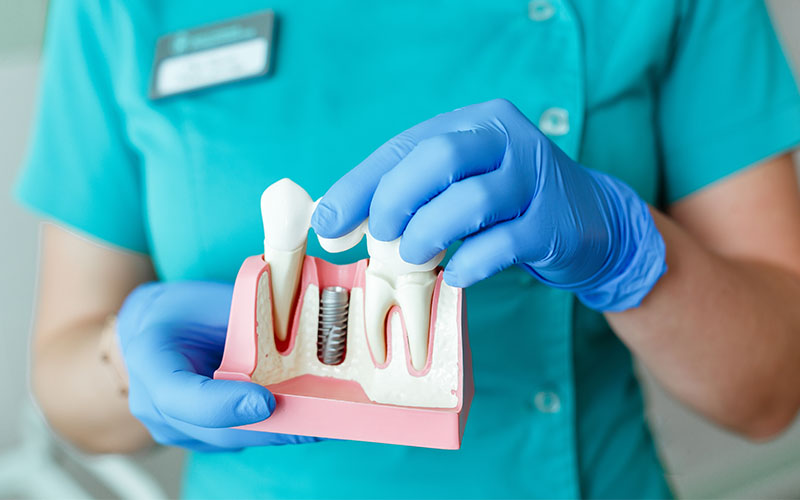 Dental Implants: A Comprehensive Guide