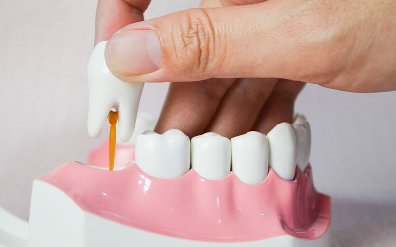 Dental Implants: A Permanent Solution for Missing Teeth