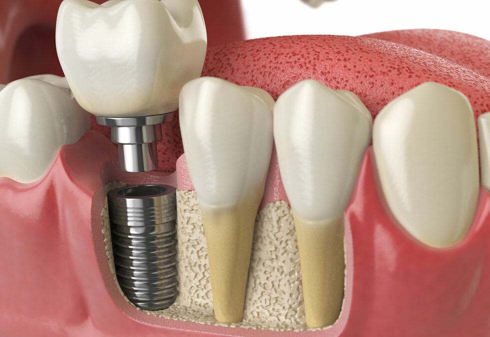 How Long Does the Dental Implant Process Take from Start to Finish?
